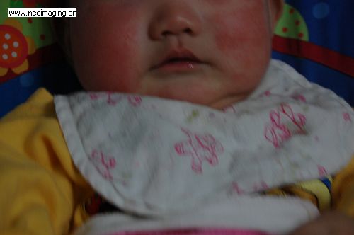 宝宝脸上红疹; 小孩脸上长湿疹图片; 