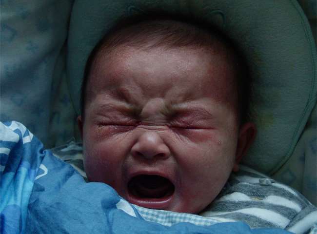 婴儿湿疹奶癣宝宝之父母湿疹手册-低敏奶粉大