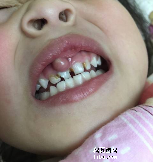 妈妈问题:宝宝牙龈经常出脓包是怎么回事?和牙齿有关系吗?