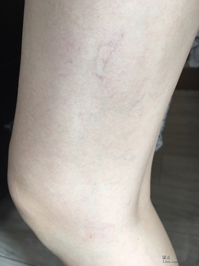 大腿上的紫色毛细血管明显说明什么问题附二张图